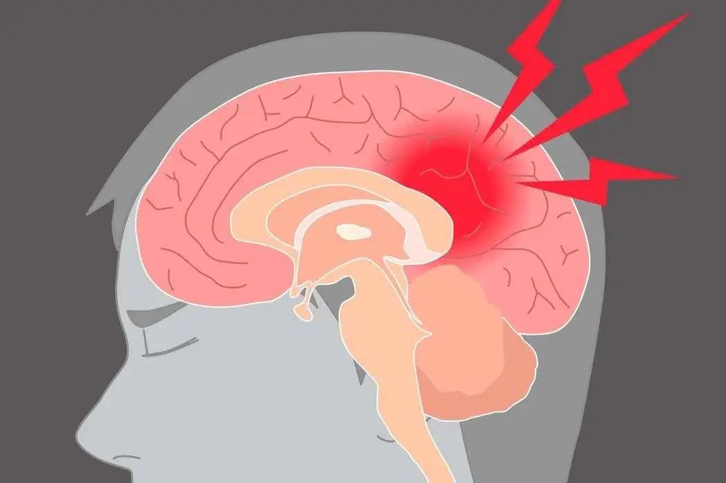 預(yù)防腦梗從習(xí)慣做起，這三大壞習(xí)慣，有的趕緊改正！